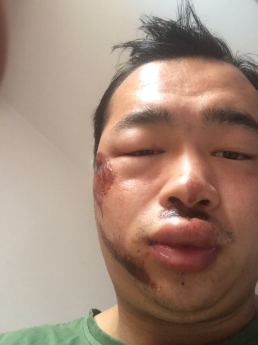 面部摔伤几个月不消肿的原因及应对措施
