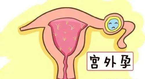 宫外孕一个月的症状
